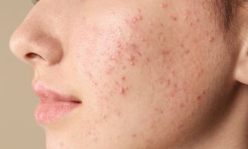 Acne products causing side effects? Try homeopathy